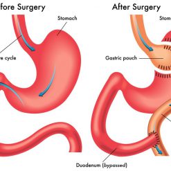 عملية جراحية في المعدة