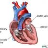 جراحة استبدال صمام القلب