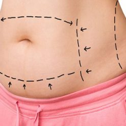 شفط دهون البطن والضلع وحقن الدهون في الأرداف - الدكتور أرجانج قهرماني