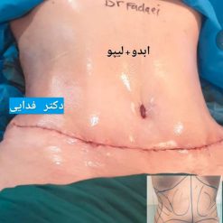 جراحة تجمیل البطن في ايران - دکتورمحسن فدائی