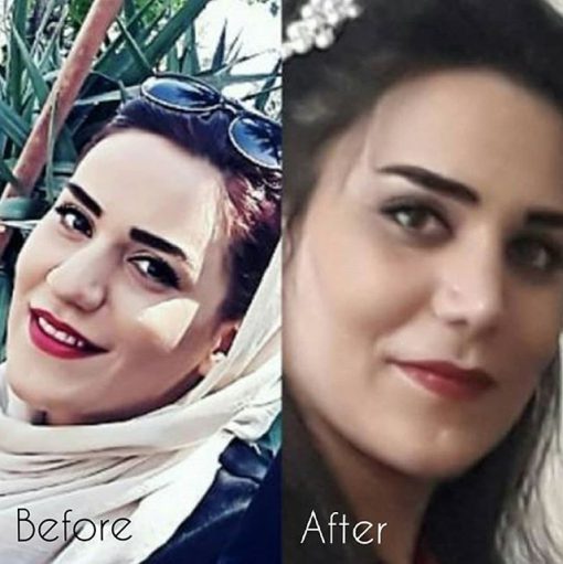 تجميل الأنف قبل وبعد الصورة في إيران