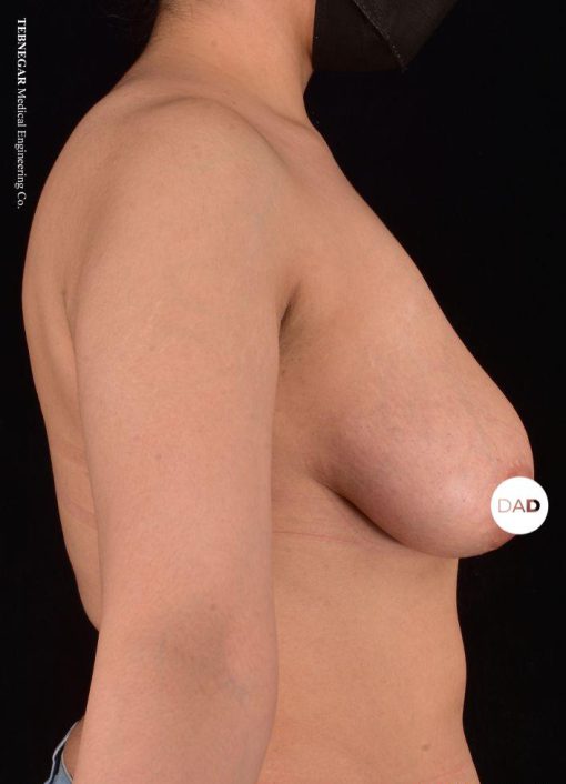جراحة تصغير الثدي في إيران - الدكتور أمير درياني