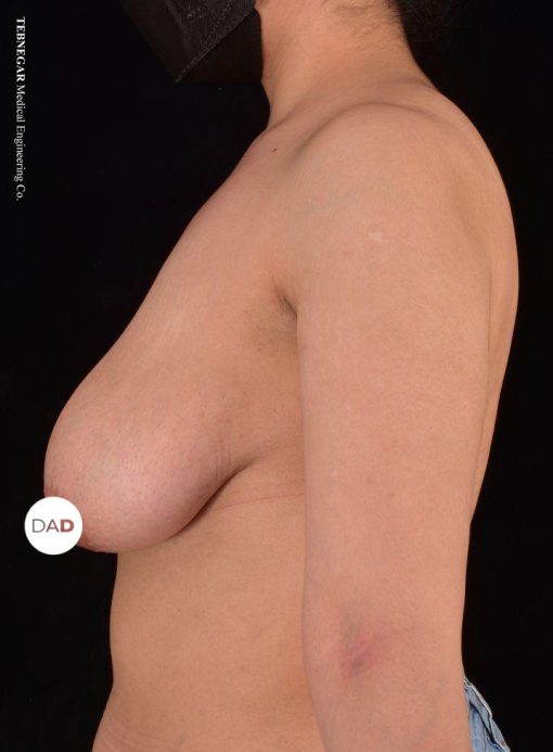 جراحة تصغير الثدي في إيران - الدكتور أمير درياني