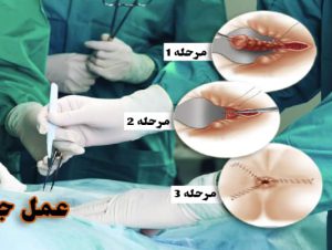 جراحة البواسير في ايران