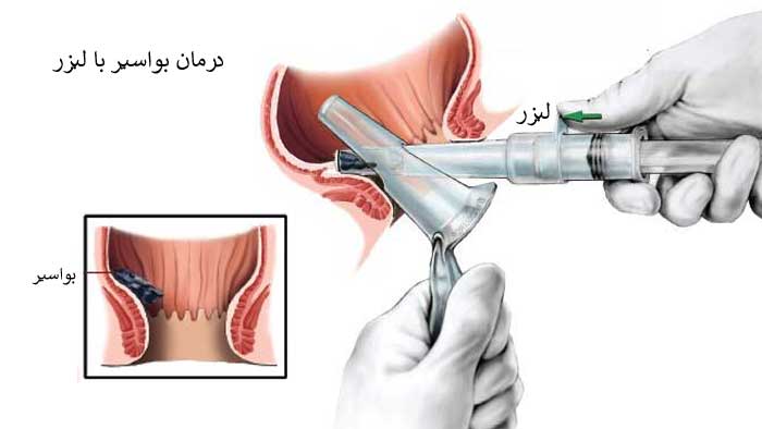 جراحة البواسير بالليزر في ايران