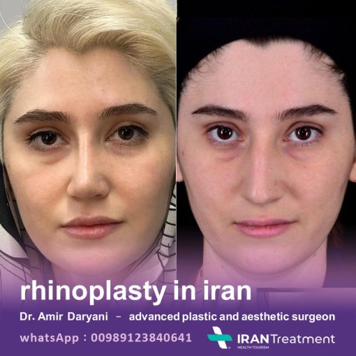 جراحة تجميل الأنف في ايران - الدكتور أمير درياني