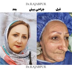 الدكتور رجببور - جراح الأنف الإيراني