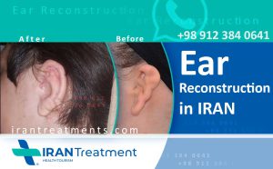 إعادة بناء الأذن في إيران