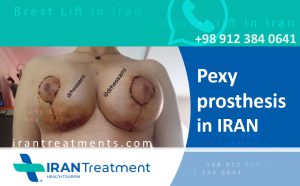 تكبير الثدي في إيران - بدلة Pexy - أفضل الجراحين والسعر
