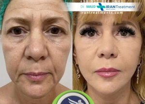 جراحة شد الوجه في إيران - أفضل جراح تجميل