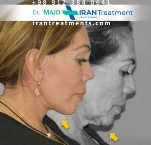 جراحة شد الوجه في إيران - أفضل جراح تجميل