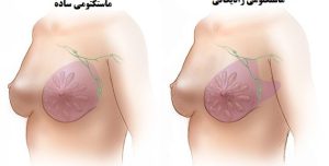 جراحة إزالة الثدي في إيران